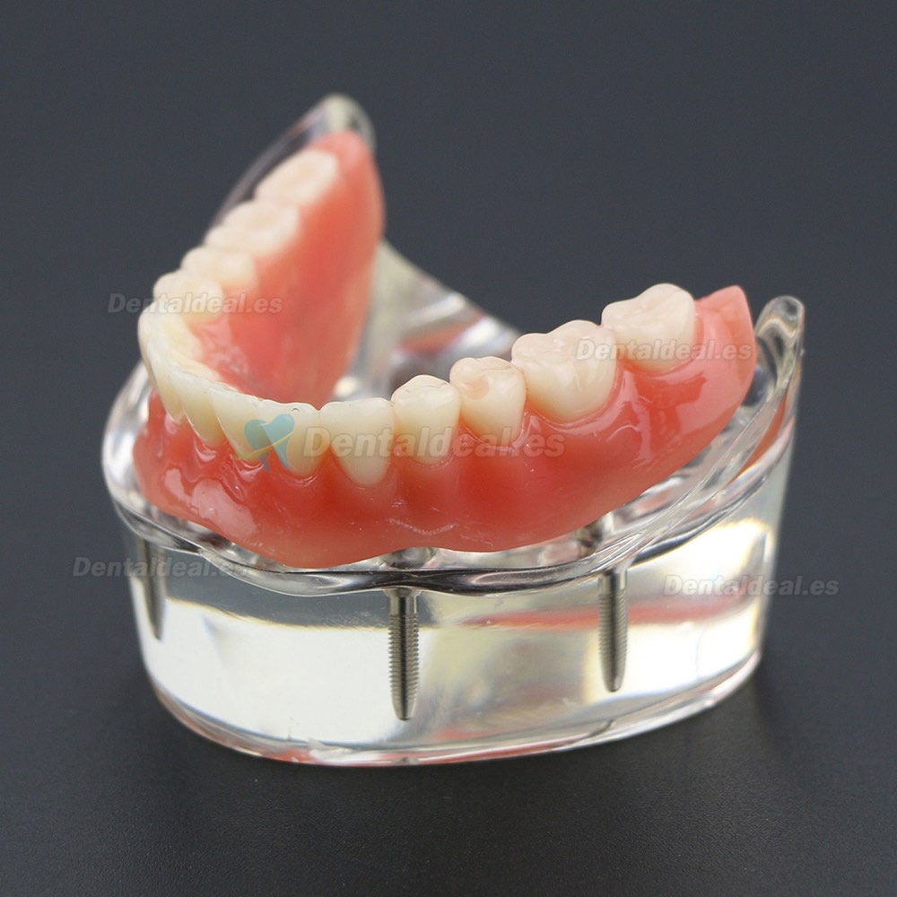 Dientes inferiores dental Modelo de sobredentadura 4 implantes Demostración Modelo 6002 02